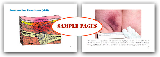 How to Identify, Stage, and Document Pressure Ulcers and Other Common Wounds