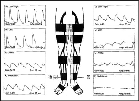 Pulse volume recordings for demonstrating pre-existing vascular occlusive disease