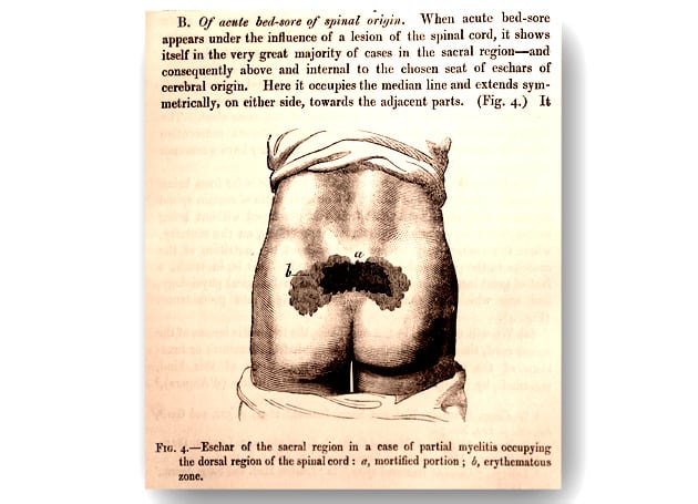 charcot-early-pressure-ulcer-decubitus-illustration