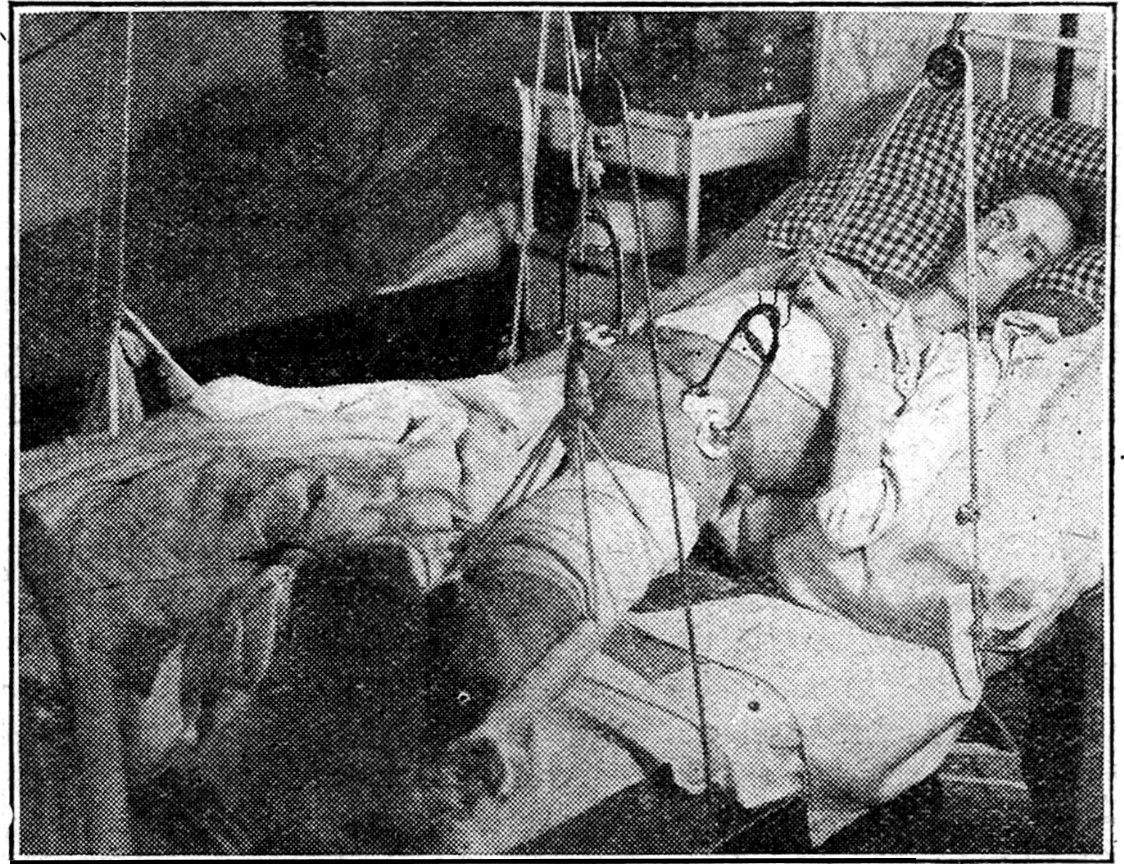Suspension therapy for pressure ulcers (bedsores) developed by Nazi doctors